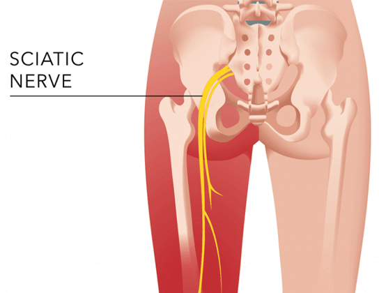 Sciatica(नसों का दर्द)